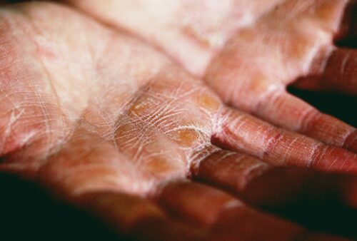 The Blueprint of a Problem: Engineering a Stronger Dermal Foundation