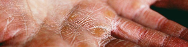 The Blueprint of a Problem: Engineering a Stronger Dermal Foundation